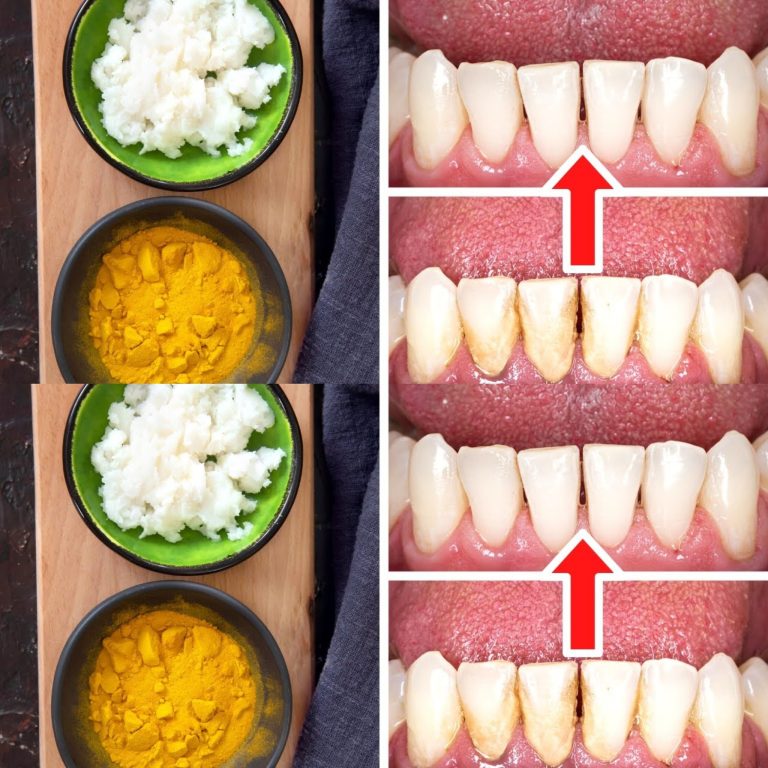 Jak usunąć kamień i osad nazębny bez dentysty: kurkuma i sól