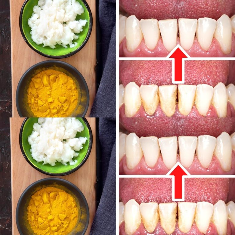 Jak usunąć kamień i osad nazębny bez dentysty: kurkuma i sól
